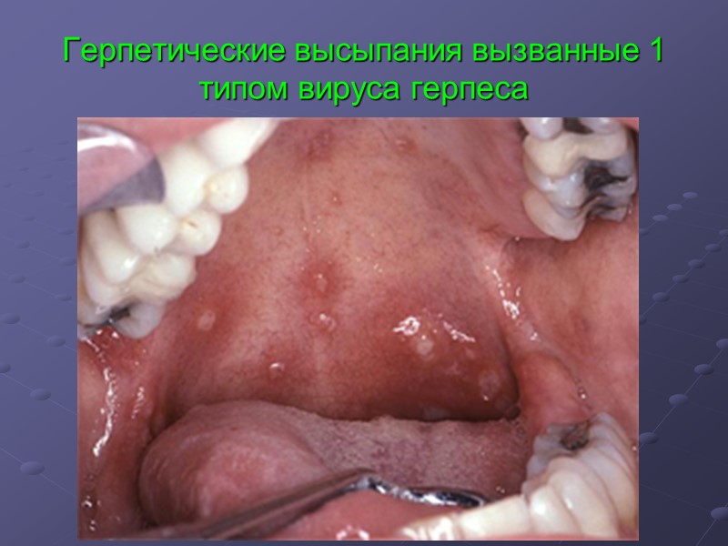 Герпетические высыпания вызванные 1 типом вируса герпеса